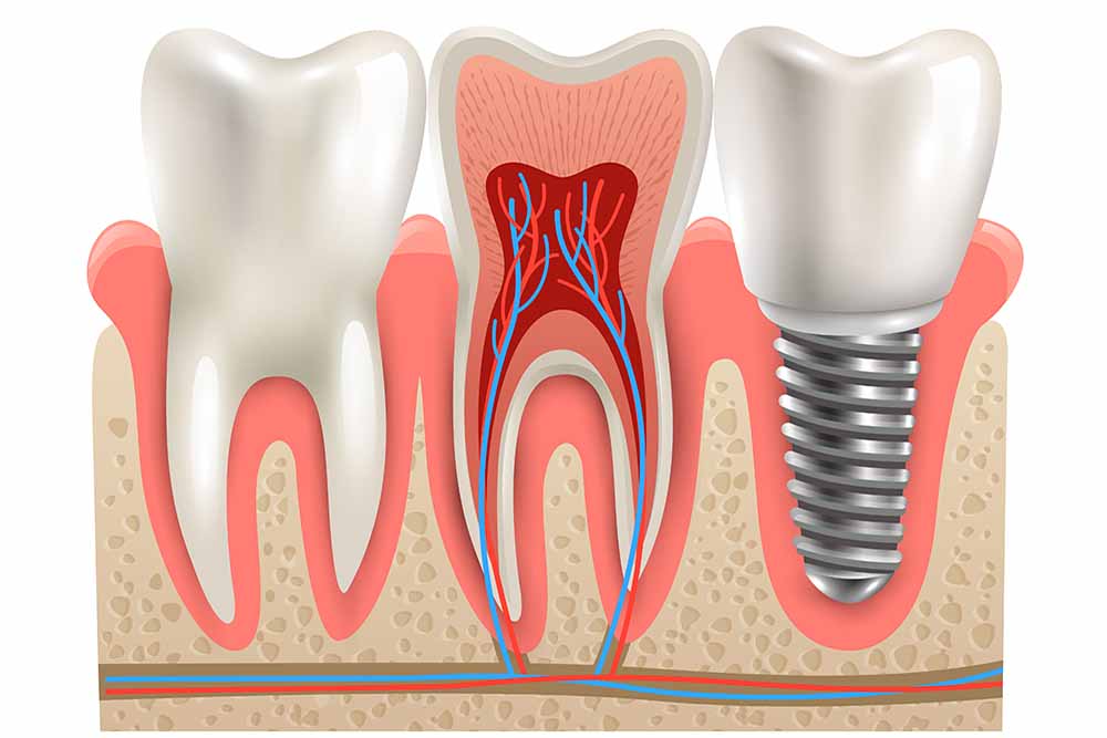 Single Sitting Root Canal