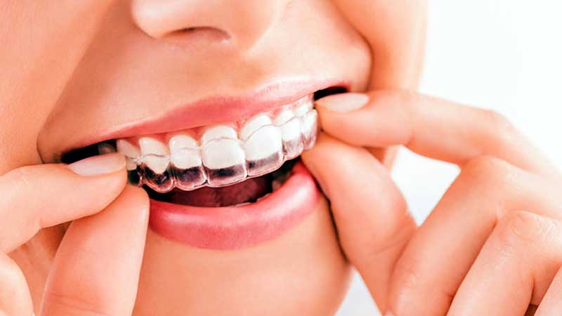 Aligners Treatment