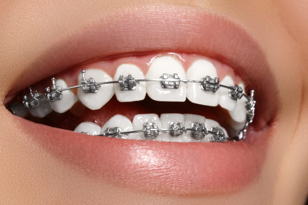 Orthodontic treatment